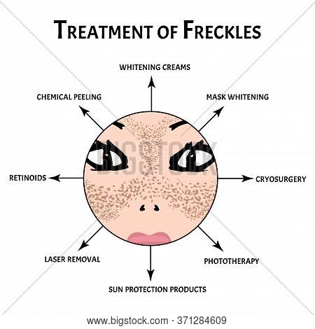 Freckles On The Face. Pigmentation On The Skin. A Pigmented Spot On The Skin Of The Face. Treatment.