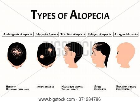 Types Of Alopecia. Bald Spot, Baldness, Alopecia Mesotherapy. Causes Of Baldness. Infographics. Illu