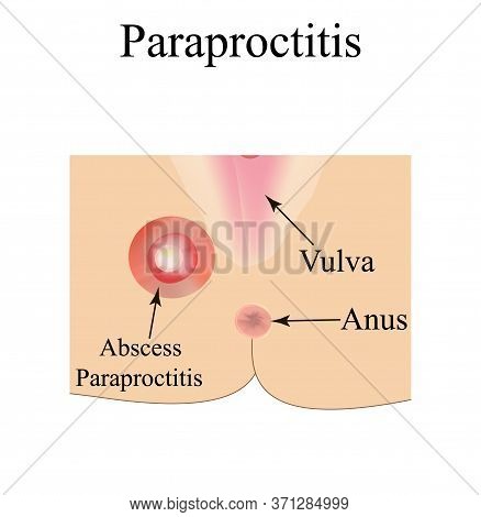 Paraproctitis. Abscess In The Perineum. Inflammation Paraproctitis. Infographics. Illustration On Is