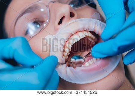Dental Treatment With Expander. Modern Medical Technology