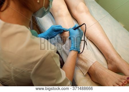 Close Up View Of Doctor Doing Electro Epilation, Hair Removal To Client.