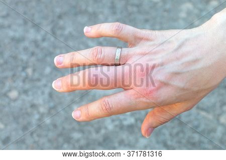 Right Hand With A Swollen Large Middle Finger After A Bee Bite With A Wedding Ring, Enlarged In Size