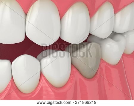 3d Render Of Jaw And Lower Premolar Tooth With Dead Pulp