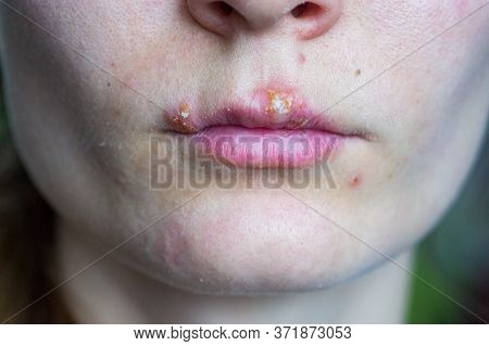 Herpes Disease On The Lips Of A Young Girl. Wounds From Herpes On The Lips Of A Person. Herpes Foci.