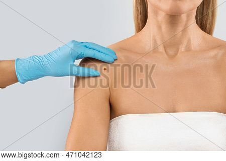 Doctor Hand Checking Mole Nevus On Unrecognizable Womans Shoulder