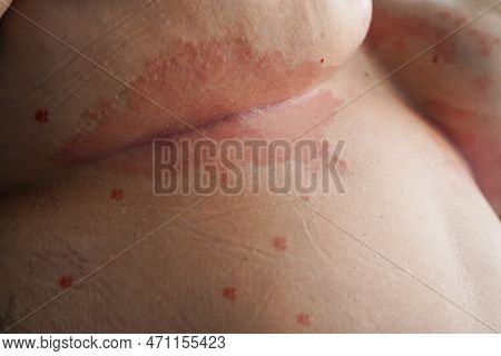 Psoriasis Skin. Psoriasis Is An Autoimmune Disease That Affects The Skin Cause Skin Inflammation Red