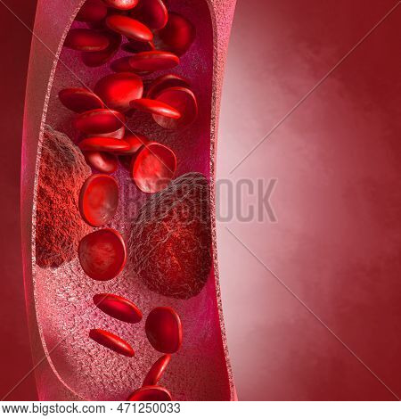 Medical Background, Cholesterol Plaque In The Artery, Increased Level, 3d Illustration