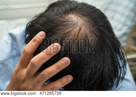 Bald In The Middle Head And Begin No Loss Hair Glabrous Of Mature Asian Business Smart Active Office
