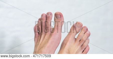A Mans Toes Showing What Looks Like A Rash With Red Blotchy Skin. A Common Side Effect Of Covid-19 O