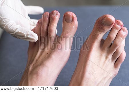 A Mans Toes Showing What Looks Like A Rash With Red Blotchy Skin. A Common Side Effect Of Covid-19 O