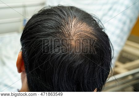 Bald In The Middle Head And Begin No Loss Hair Glabrous Of Mature Asian Business Smart Active Office