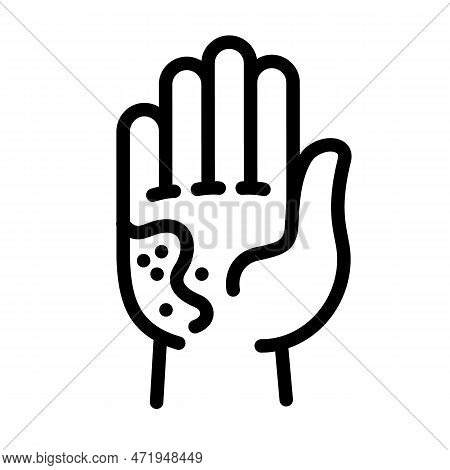 Kid Hand Frostbite Icon. Outline Kid Hand Frostbite Icon For Web Design Isolated On White Background