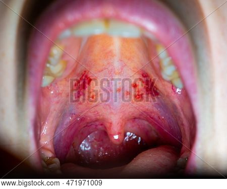 Inflamed Throat Of A Sick Person, Red Blood Vessels Of The Upper Wall Of The Oral Cavity