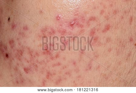 Closeup Skin Problems, Nodular Cystic Acne Skin