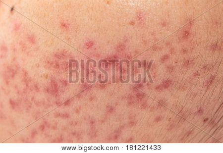 Closeup Skin Problems, Nodular Cystic Acne Skin