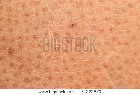 Closeup Of Skin Problem,dry Skin Ichthyosis Vulgaris