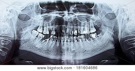Panoramic dental x-ray scan orthopantomogram of the mouth the upper and lower jaws for oral surgeries and implantology. elderly person.