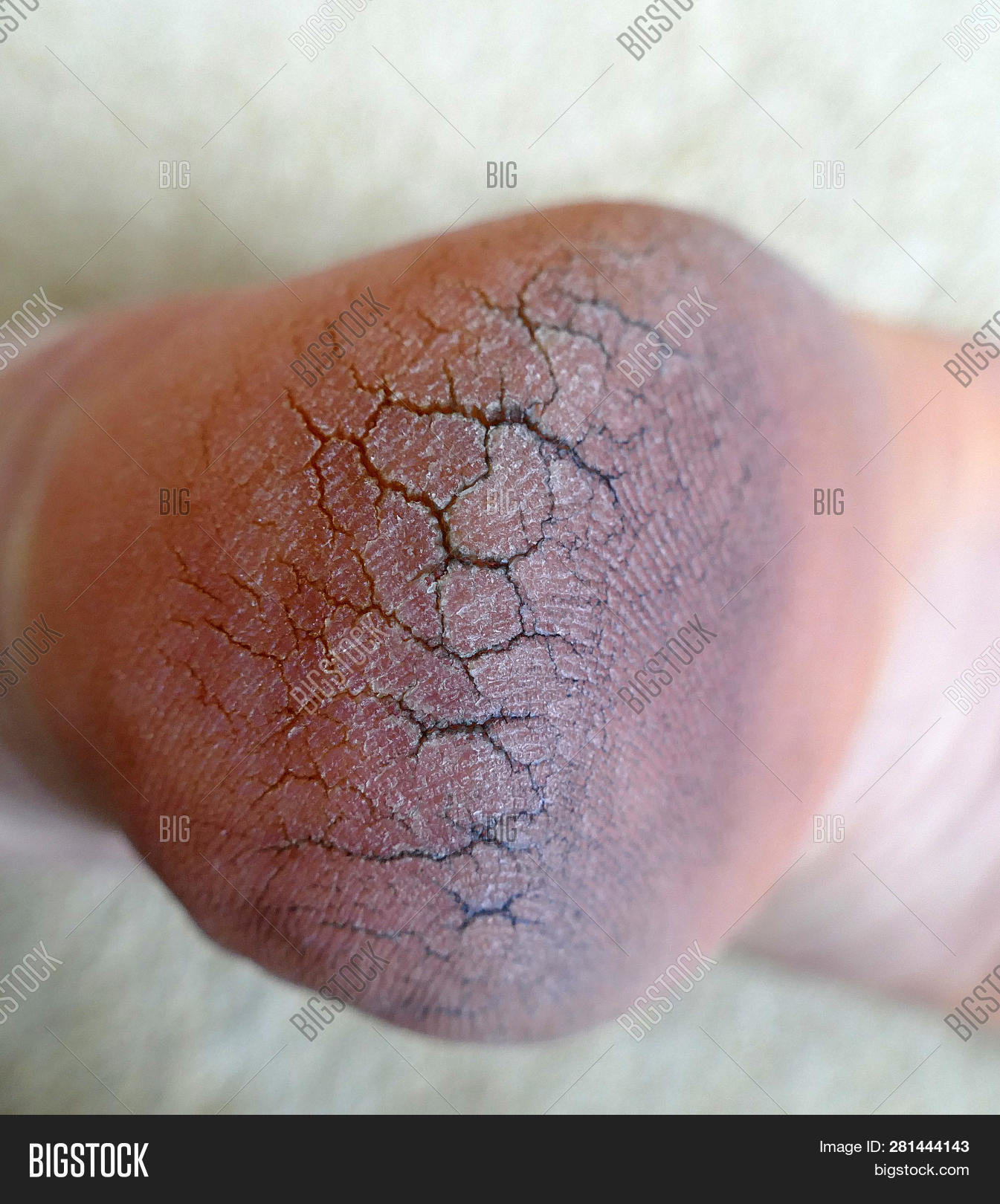 Human Heel Crack, Foot Image & Photo (Free Trial) Bigstock