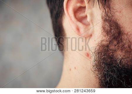 Festering Pimple On A Mans Neck, The Bearded Man Has Problems With Skin