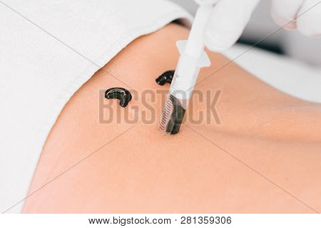 Patient During Leech Therapy, Alternative Hirudotherapy, Blood Purification