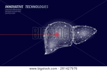 Human Liver Laser Surgery Operation Low Poly. Medicine Disease Drug Treatment Painful Area. Red Tria