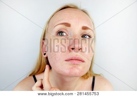 Oily And Problem Skin. Portrait Of A Blonde Girl With Acne, Oily Skin And Pigmentation