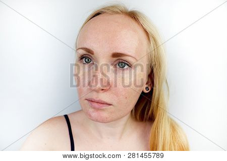 Oily And Problem Skin. Portrait Of A Blonde Girl With Acne, Oily Skin And Pigmentation