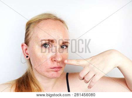 Oily And Problem Skin. Portrait Of A Blonde Girl With Acne, Oily Skin And Pigmentation