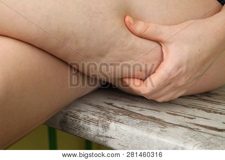 Woman Shows Holding And Pushing The Skin Of The Legs Cellulite, Orange Peel.