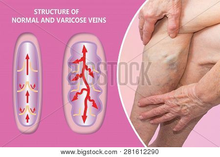 Varicose Veins On A Female Senior Legs. The Structure Of Normal And Varicose Veins. Concept Of Dry S