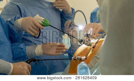 Endoscopy, Laparoscopy, Surgery. The Team Of Surgeons Performs An Operation Using Medical Endo-video