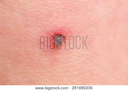 The Tick Bites The Person, Sucked Deep Under The Skin