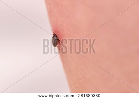 The Tick Bites The Person, Sucked Deep Under The Skin
