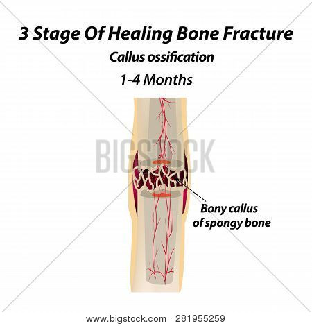 3 Stage Of Healing Bone Fracture. Callus Ossification. The Bone Fracture. Infographics. Vector Illus