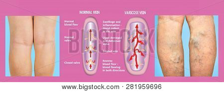 Varicose Veins On A Female Senior Legs. The Structure Of Normal And Varicose Veins. Concept Of Dry S