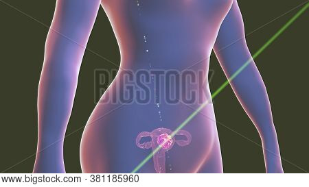 Uterine Cancer, 3d Illustration Showing Malignant Tumor In The Female Uterus. Concept Of Uterine Can