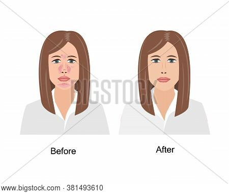 Woman Suffering From Seborrheic Dermatitis Before And After Medical Treatment. Vector Illustration. 