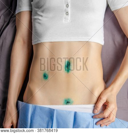 Middle Age Caucasian Female Shows Her Healing  Scars After Laparoscopic Appendix Removal Surgery