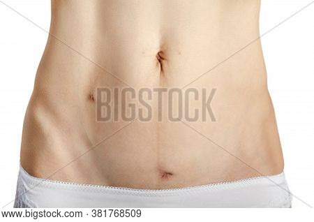 Middle Age Caucasian Female Shows Her Healing  Scars After Laparoscopic Appendix Removal Surgery. Wh