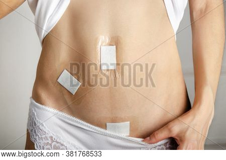 Caucasian Model Demonstrates Abdomen After Laparoscopic Appendix Removal Surgery