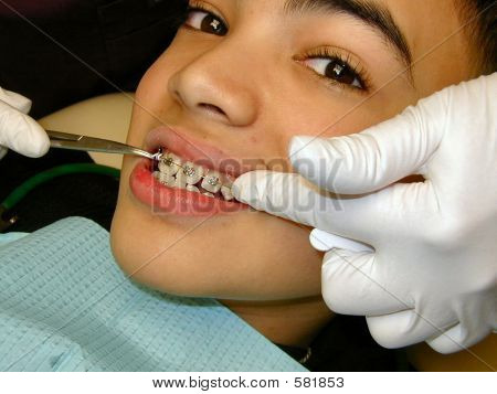 Установка брекетов