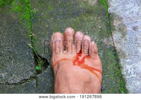 foot wound becomes infected with apply medication select focus with shallow depth of field.