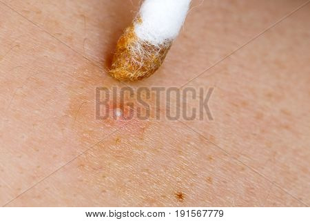 Photo of acne home remedy with propolis