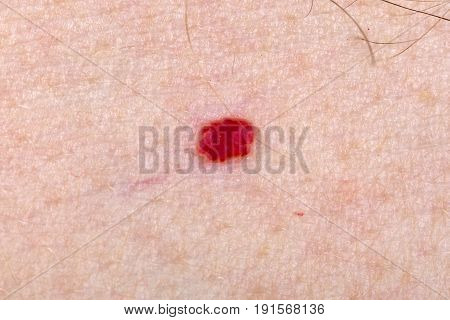 Close up photo of cherry angioma on human skin