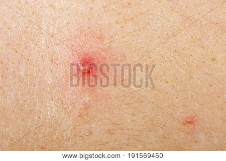 Close up photo of acne on skin
