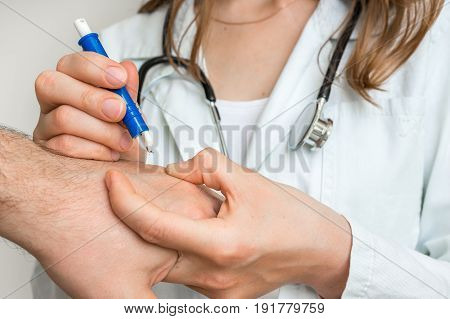 Doctor Removing A Tick With Tweezers From Hand Of Patient