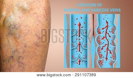 Varicose Veins On A Female Senior Legs. The Structure Of Normal And Varicose Veins. Concept Of Dry S