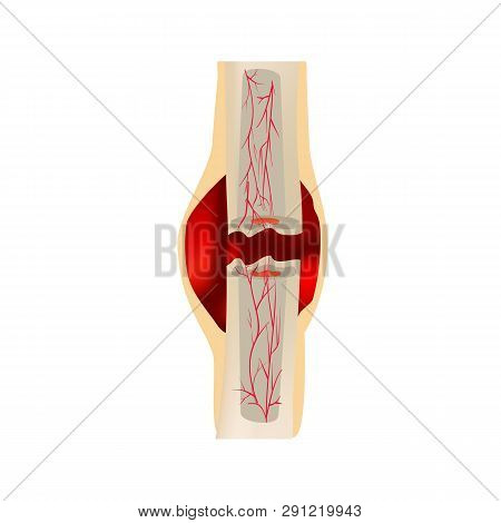 1 Stage Of Healing Bone Fracture. Formation Of Callus. Hematoma. The Bone Fracture. Infographics. Ve