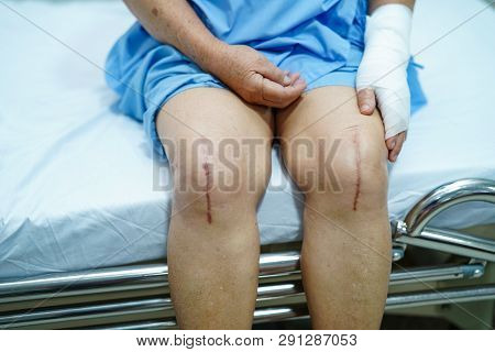 Asian Senior Or Elderly Old Lady Woman Patient Show Her Scars Surgical Total Knee Joint Replacement 