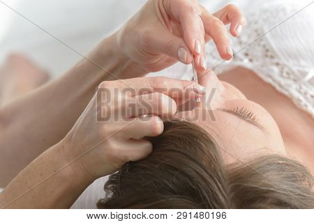 Acupuncture therapist applying acupuncture needle to her client's head